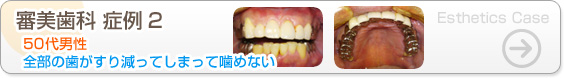 審美歯科症例2